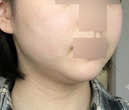 Before surgery thumbnail