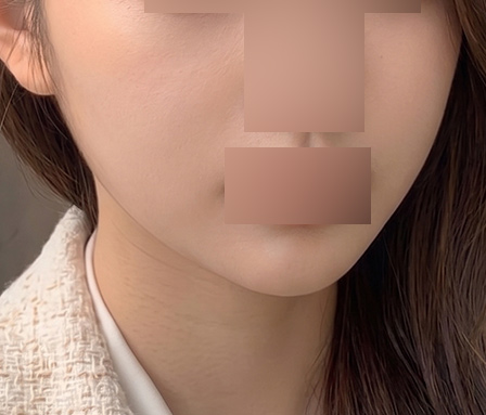 턱라인 심부볼 - After Surgery