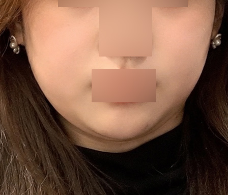 턱라인 심부볼 - Before Surgery