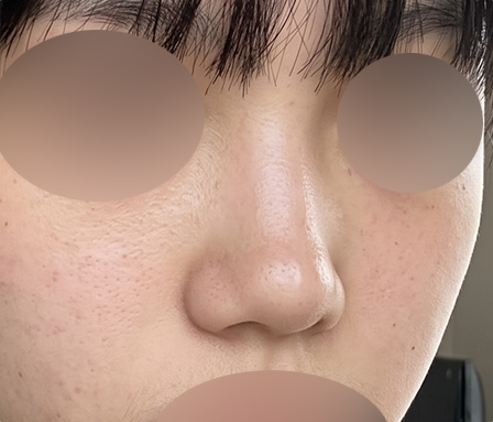 코재수술 - Before Surgery